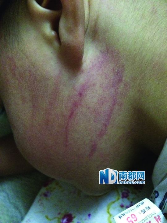 小逸臉上淤痕清晰可見(jiàn)。