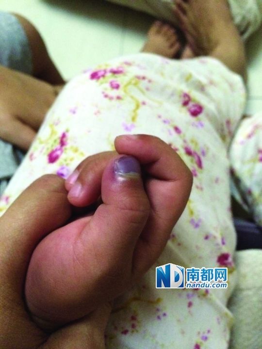 小逸手指被夾傷。