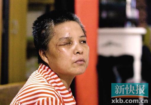 4月初,趙女士遭人搶劫并被打傷,現(xiàn)今右眼失明,頭部被縫100多針。記者 畢志毅/攝