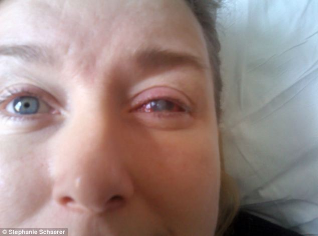 恐怖慎入！隱形眼鏡致英女子摘除眼球