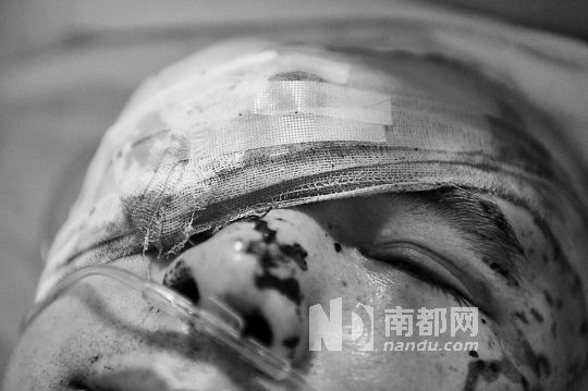 李建新頭部還有被潑硫酸的痕跡，醫(yī)生說被砍傷的右眼已經(jīng)失明。 南都記者 田飛 攝