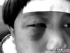 6月2日，網(wǎng)曝渭南市臨渭區(qū)一不滿5歲的女童遭奶奶毆打，眼圈青腫，引起網(wǎng)友關(guān)注，但孩子父母和爺爺均稱是摔倒導致。相關(guān)部門介入調(diào)查發(fā)現(xiàn)確為奶奶毆打所致，鑒于其身體原因已進行批評教育。