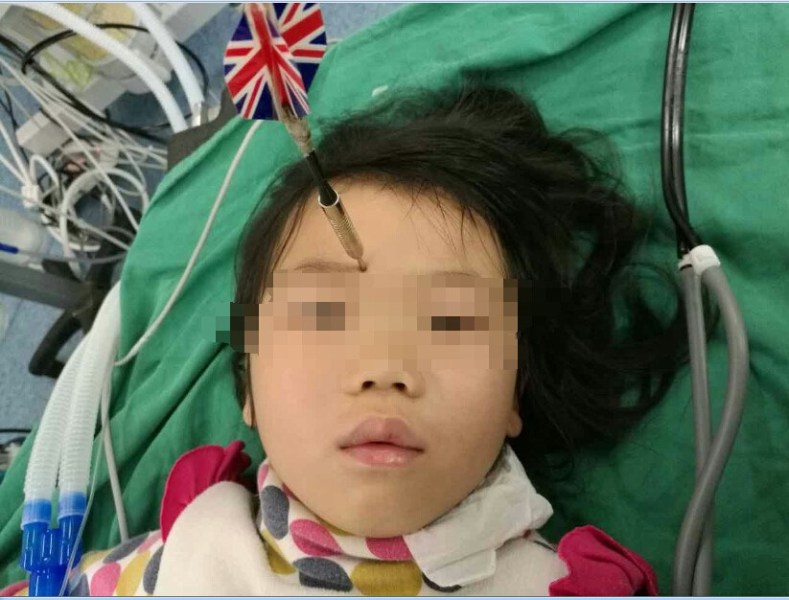 十多公分長(zhǎng)的飛鏢穩(wěn)穩(wěn)地 ” 定 ” 在了一名六歲半的女童額頭上，小青一家人凌晨從長(zhǎng)順趕到貴醫(yī)附院急診室時(shí)，看到如此慘烈的情況，接診醫(yī)生都嚇了一跳。詳細(xì)詢問(wèn)下得知，原來(lái)是七歲的哥哥和六歲半的表妹在玩耍時(shí)，哥哥不慎將路邊撿來(lái)的真飛鏢扎到了妹妹的額頭上。