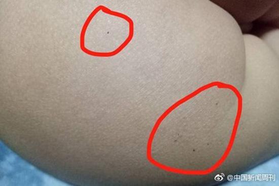 據(jù)多名紅黃藍(新天地分園)家長反映，孩子腿部、屁股、腋下出現(xiàn)針眼。