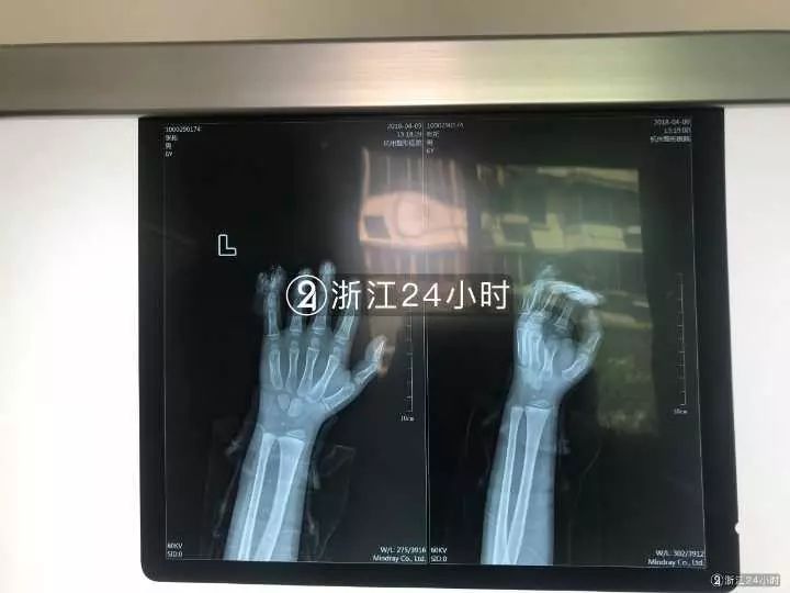 嚇哭！6歲男孩被夾斷手指 罪魁禍?zhǔn)拙故切７? oldsrc=