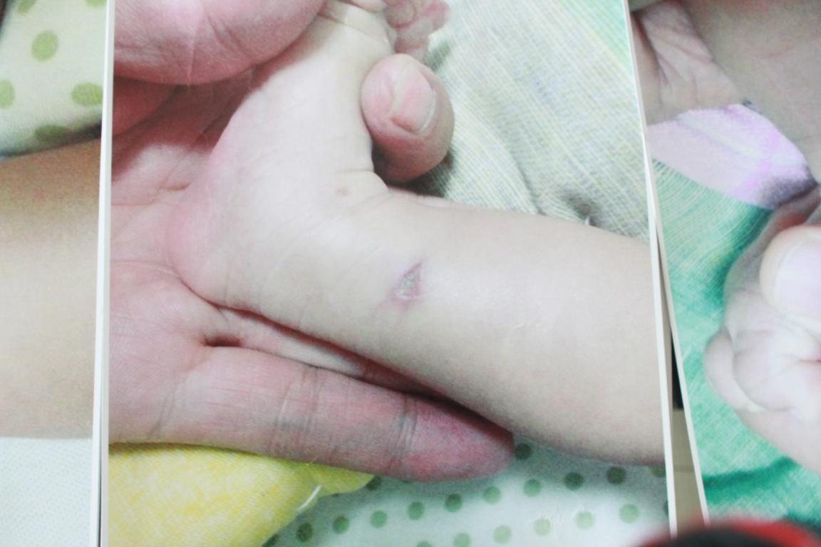 孩子腿部的傷口照片 （患兒家長(zhǎng)提供）