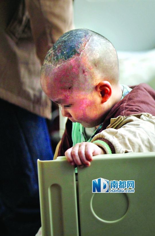 1月8日下午，小寶頭上和臉上都是傷痕。