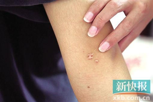取出針后李星兒手臂留下了傷口。新快報(bào)記者 張國(guó)鋒/攝