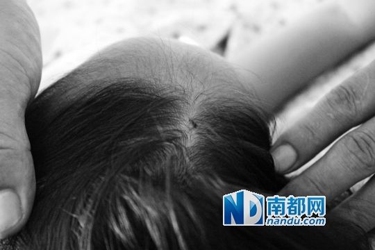 女童頭上被扎的針孔（圓圈處）。賈先生說，被扎不到三秒鐘，女兒就昏了。