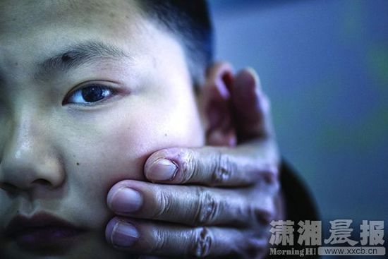 1月13日，小玨的父親心疼地摸著兒子的臉。