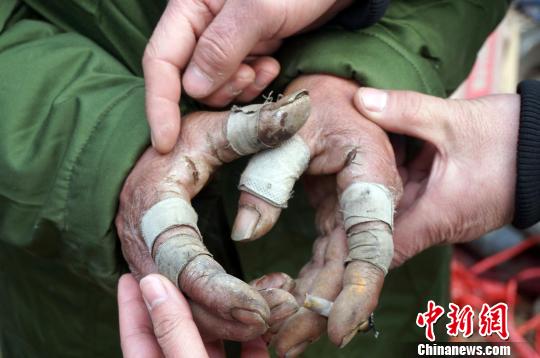 圖為由于常年拾荒，老人雙手布滿傷口。周小云 攝
